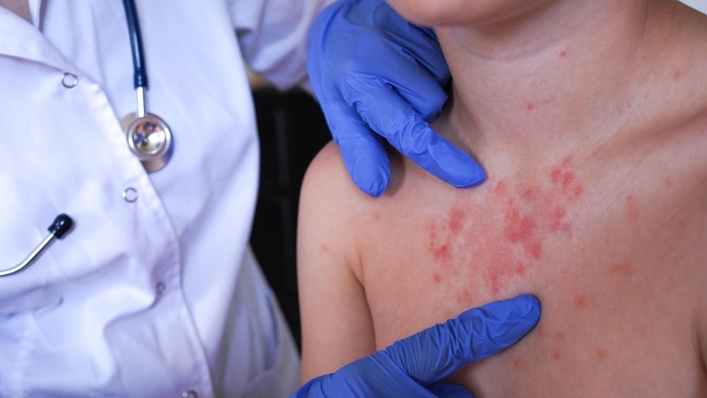Minnesota's 80 measles cases this year are the most since 1990, health officials say — Stillwater Health news